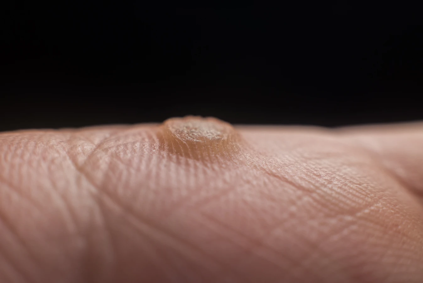 Co ile zamrażać kurzajki?